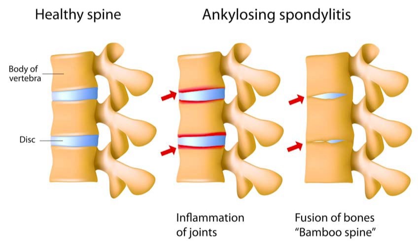 Σπονδυλοαρθρίτιδες