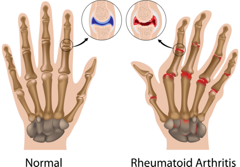 Κρυσταλλική αρθρίτιδα