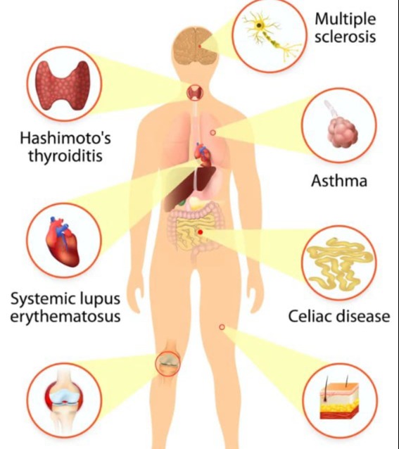 Αυτοανοσοποιητικές παθήσεις