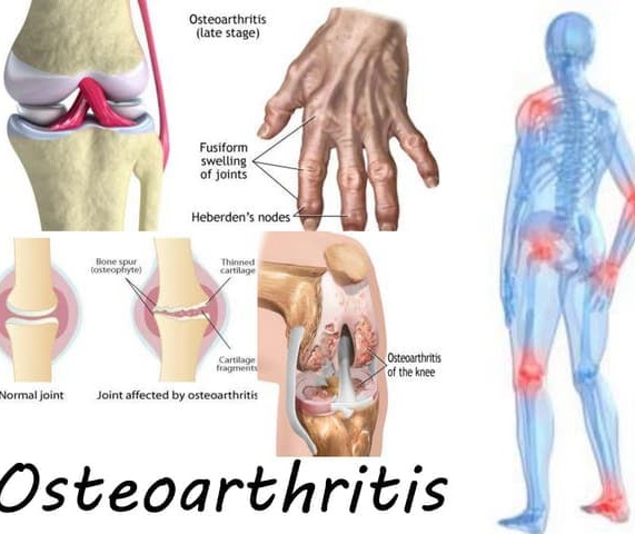 Οστεοαρθρίτιδα