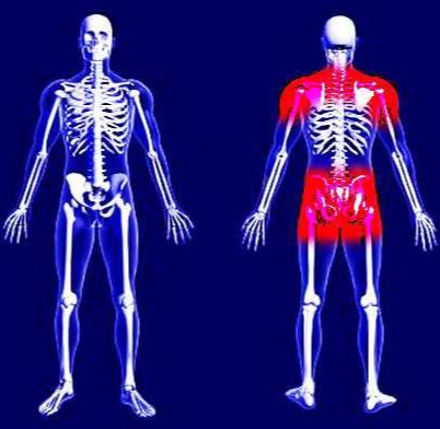 Ρευματική Πολυμυαλγία