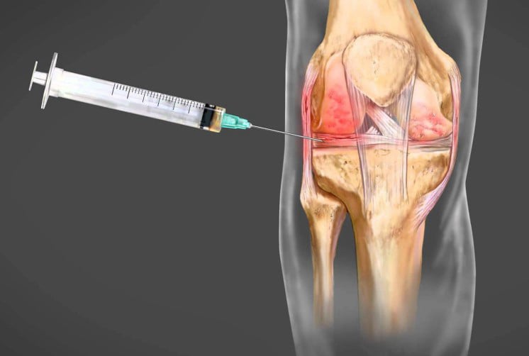 Αρθροκέντηση