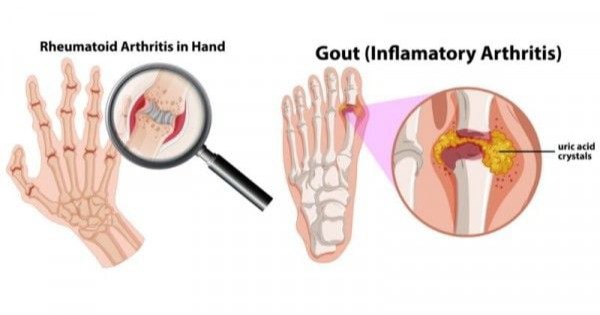 Ρευματοειδής αρθρίτιδα