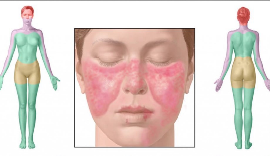 Συστηματικός Ερυθηματώδης Λύκος